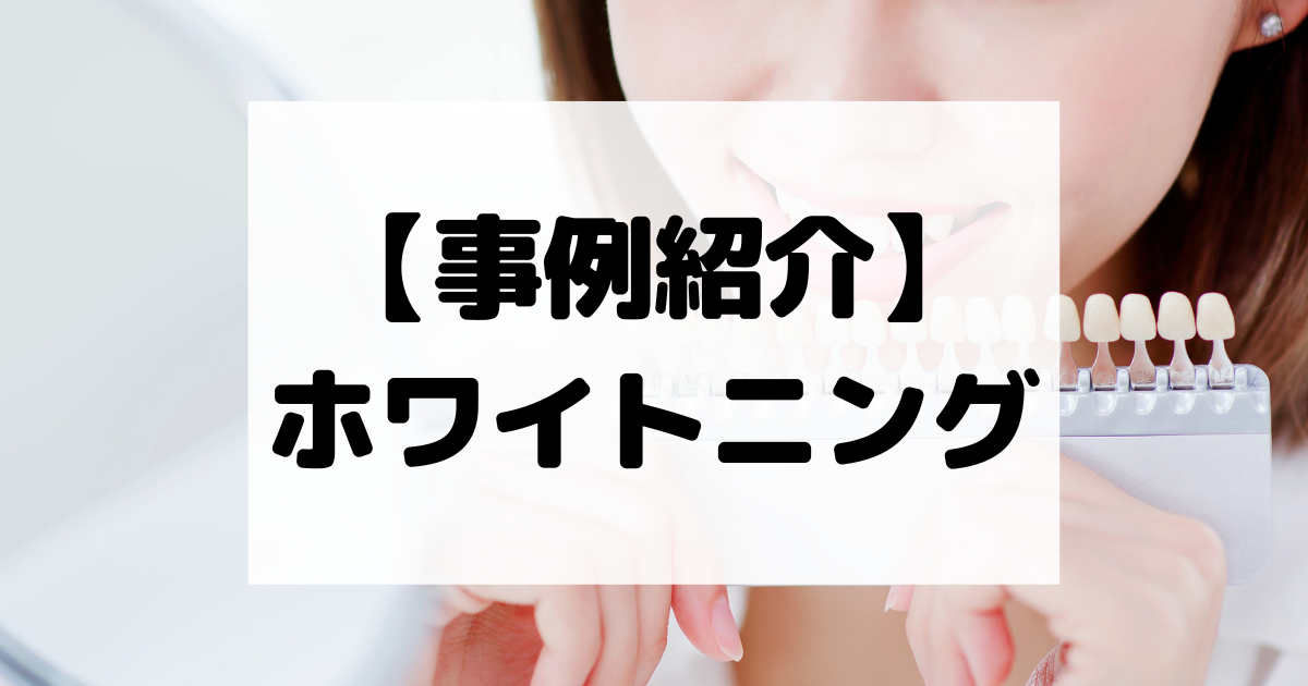 【事例紹介】ホワイトニング【コスパ広告くん】